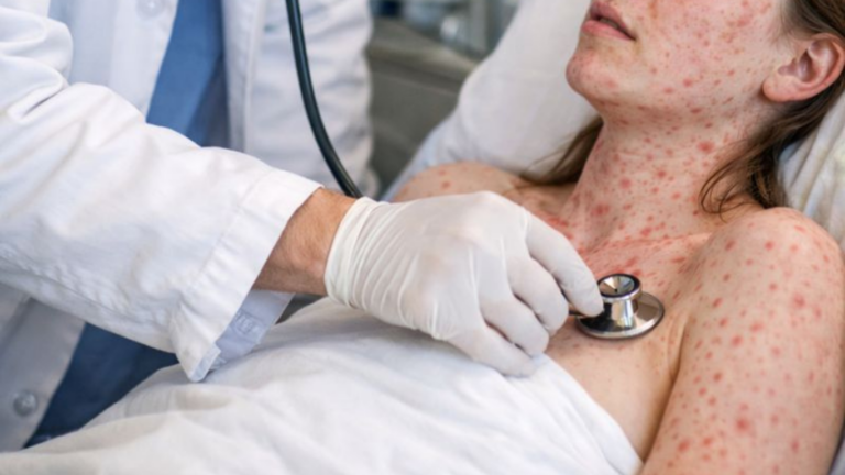 Sarampo volta a desafiar médicos em 2025: como combater a desinformação e proteger seus pacientes