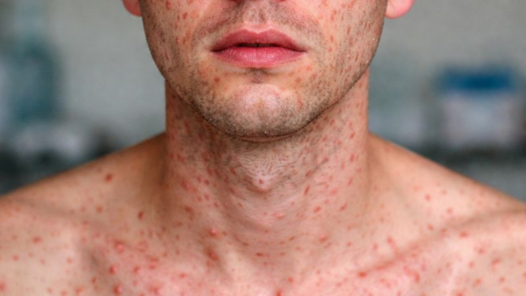 Sarampo volta a desafiar médicos em 2025: como combater a desinformação e proteger seus pacientes